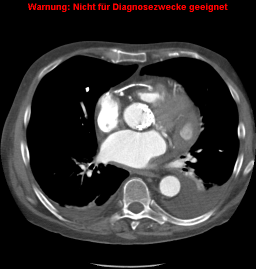 File:Cardiac perforation following transcatheter aortic valve implantation (Radiopaedia 23714-23863 A 4).png
