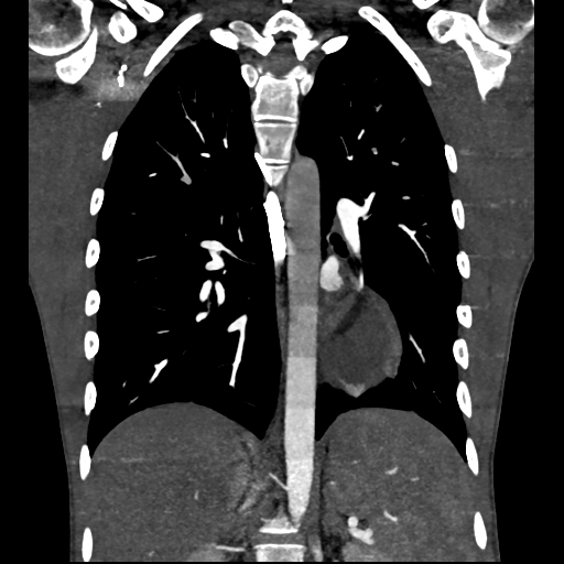 Cardiac tumor - undifferentiated pleomorphic sarcoma (Radiopaedia 45844-50134 Coronal non-contrast 45).png