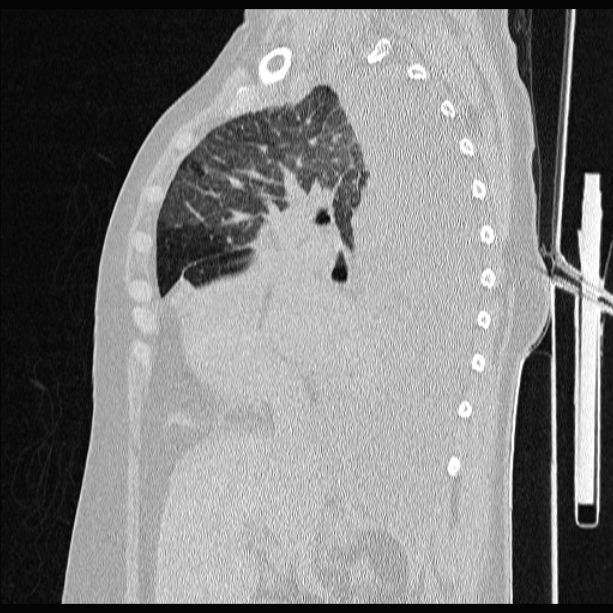 Cardiogenic pulmonary edema (Radiopaedia 29213-29609 Sagittal lung window 38).jpg