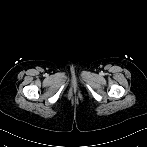 Caroli disease with medullary sponge kidney (Radiopaedia 82622-96804 C 83).jpg