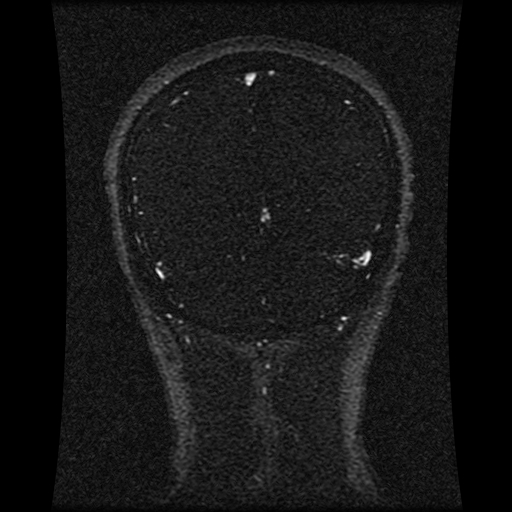 Carotid arterial dissection with acute cerebral infarction (Radiopaedia 26636-26784 MRV 59).jpg