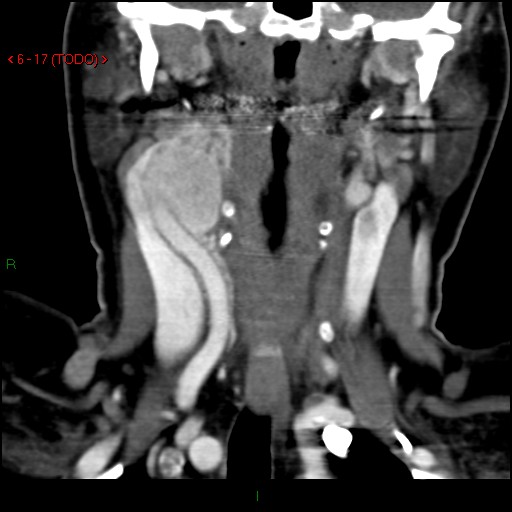 File:Carotid body tumor (Radiopaedia 20564-20462 D 1).jpg