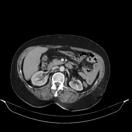 Carotid body tumor (Radiopaedia 21021-20948 A 63).jpg