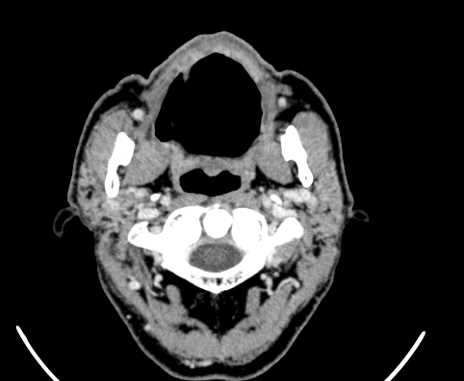 Carotid body tumor (Radiopaedia 61750-69757 Axial Post contrast 14).jpg