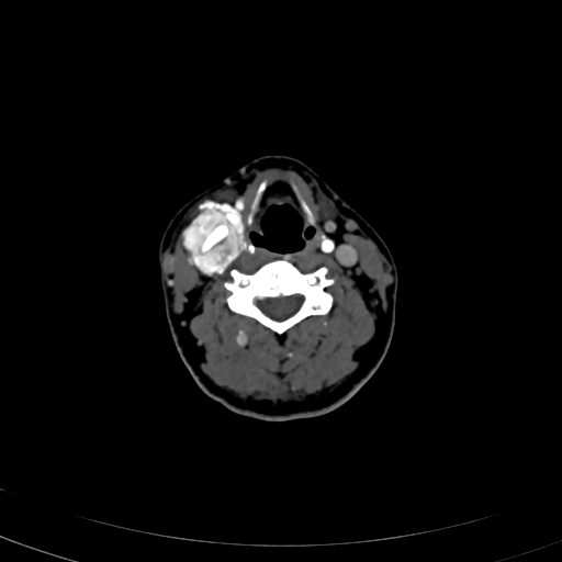 Carotid body tumor (Radiopaedia 83615-98727 A 66).jpg