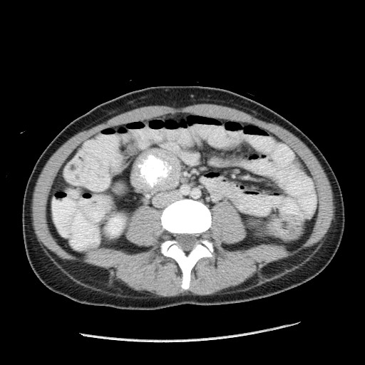 Castleman disease with fibrous pseudotumor in the abdomen (Radiopaedia 77296-89373 A 70).jpg