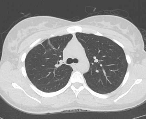 File:Catamenial pneumothorax (Radiopaedia 54382-60600 Axial 21).png