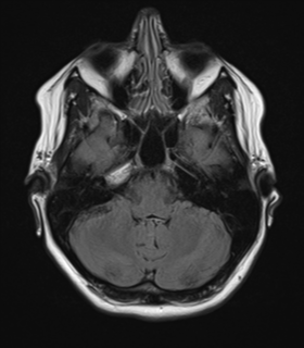 File:Cavernoma with bleed - midbrain (Radiopaedia 54546-60774 Axial FLAIR 8).png