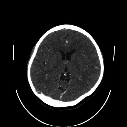 Cavernoma with developmental venous anomaly (Radiopaedia 22470-22506 C 89).jpg