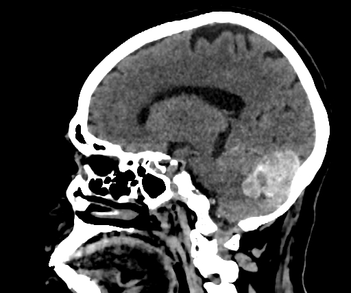 Cavernous hemangioma of the cerebellar falx (Radiopaedia 73025-83723 B 134).jpg