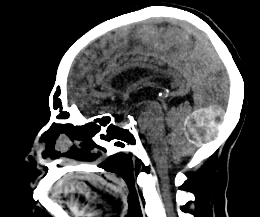 Cavernous hemangioma of the cerebellar falx (Radiopaedia 73025-83723 B 166).jpg