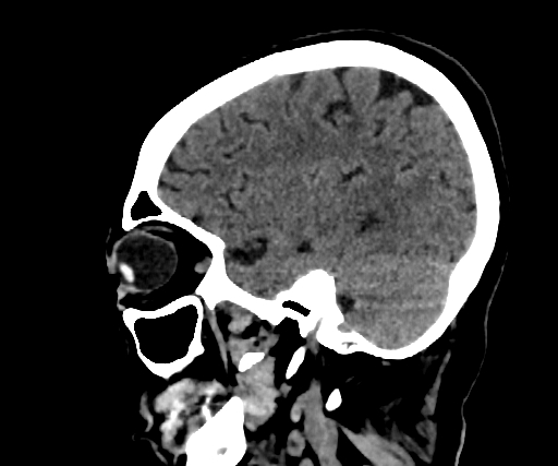 Cavernous hemangioma of the cerebellar falx (Radiopaedia 73025-83723 B 237).jpg