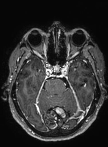 File:Cavernous hemangioma of the cerebellar falx (Radiopaedia 73025-83724 Axial T1 C+ 228).jpg