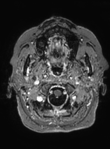 File:Cavernous hemangioma of the cerebellar falx (Radiopaedia 73025-83724 Axial T1 C+ 322).jpg