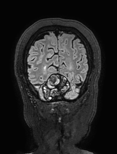 Cavernous hemangioma of the cerebellar falx (Radiopaedia 73025-83724 Coronal FLAIR 311).jpg