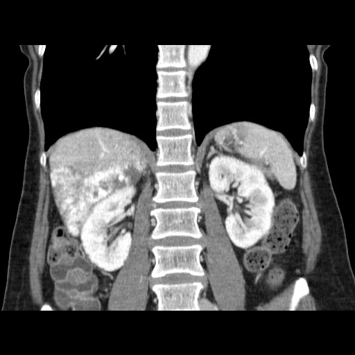 Cavernous hepatic hemangioma (Radiopaedia 75441-86667 C 93).jpg