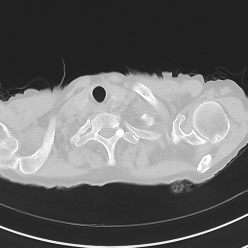 Cavitating pneumonia - lingular segments (Radiopaedia 34386-35678 Axial lung window 4).png