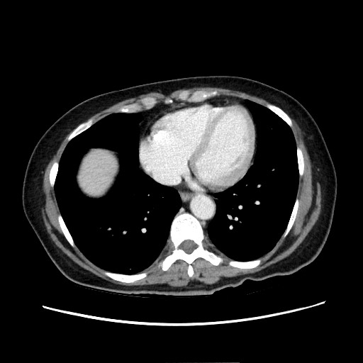 Cecal adenocarcinoma (Radiopaedia 75909-87331 A 11).jpg