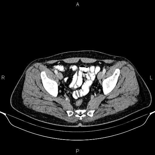 Cecal adenocarcinoma (Radiopaedia 85324-100916 B 86).jpg