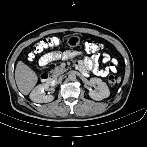 File:Cecal cancer with appendiceal mucocele (Radiopaedia 91080-108651 Axial C+ delayed 20).jpg