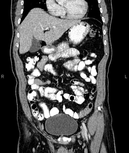 Cecal cancer with appendiceal mucocele (Radiopaedia 91080-108651 D 23).jpg