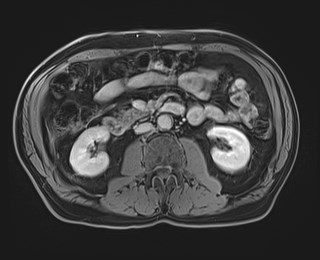 Cecal mass causing appendicitis (Radiopaedia 59207-66532 J 66).jpg