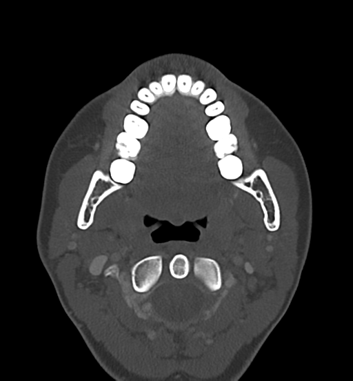 Cemento-ossifying fibroma (Radiopaedia 46243-50643 Axial bone window 37).png