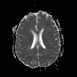 File:Central-variant posterior reversible encephalopathy syndrome (PRES) (Radiopaedia 43880-47358 Axial ADC 14).jpg