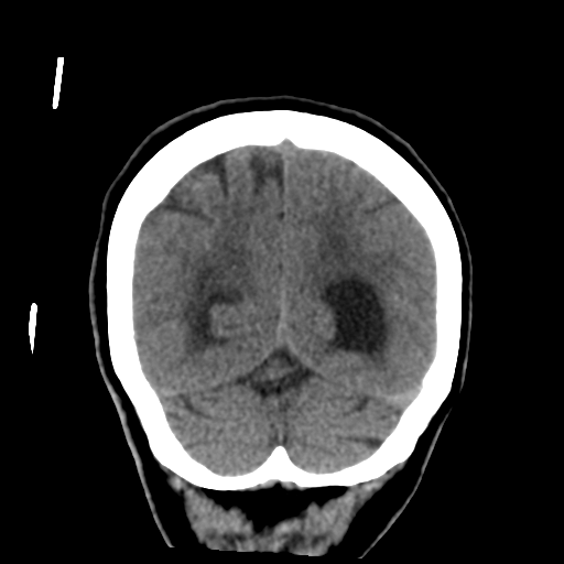 Central neurocytoma (Radiopaedia 65317-74346 Coronal non-contrast 48).png