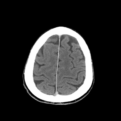 Central neurocytoma (Radiopaedia 68725-78432 Axial C+ 81).jpg