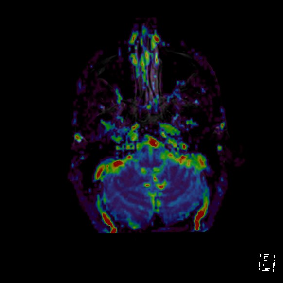 Central neurocytoma (Radiopaedia 84497-99872 Axial Perfusion 268).jpg