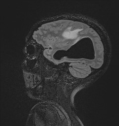 File:Central neurocytoma (Radiopaedia 84497-99872 Sagittal Flair + Gd 112).jpg