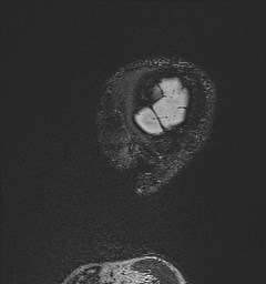 Central neurocytoma (Radiopaedia 84497-99872 Sagittal Flair + Gd 18).jpg