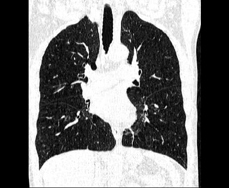 Centrilobular pulmonary emphysema (Radiopaedia 62468-70718 Coronal lung window 37).jpg