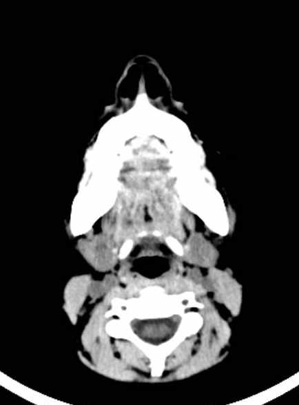 Cerebellar abscess (Radiopaedia 73727-84527 Axial non-contrast 5).jpg
