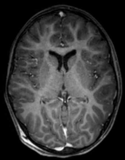 Cerebellar abscess (Radiopaedia 73727-84563 Axial T1 C+ fat sat 64).jpg