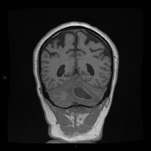 Cerebellar abscess (Radiopaedia 78135-90678 Coronal T1 C+ 123).jpg