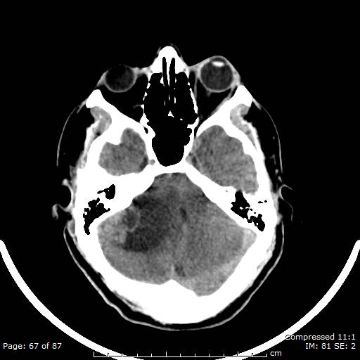 Cerebellar hemangioblastoma (Radiopaedia 52360-58258 Axial non-contrast 67).jpg