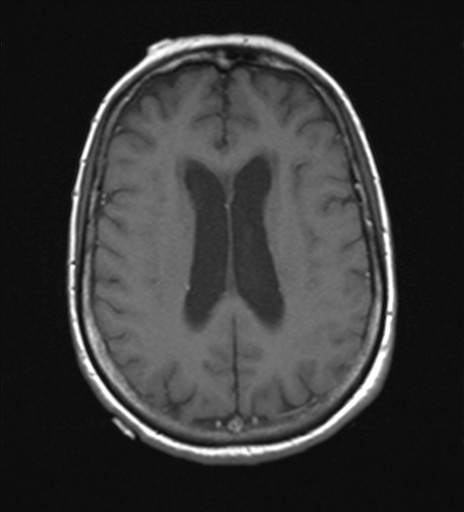 File:Cerebellar metastases (Radiopaedia 24038-24249 Axial T1 4).jpg