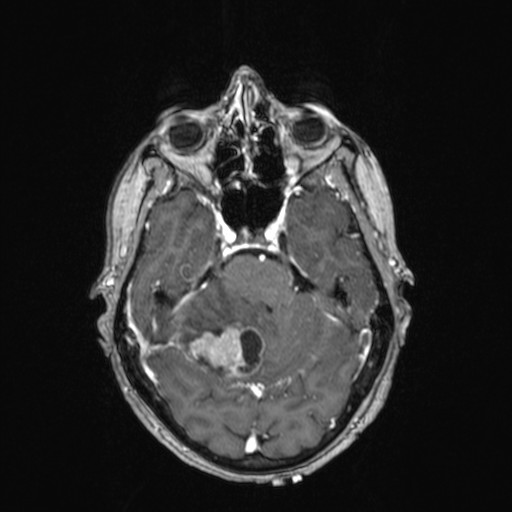 Cerebellar metastases (Radiopaedia 24038-24249 Axial T1 C+ 31).jpg
