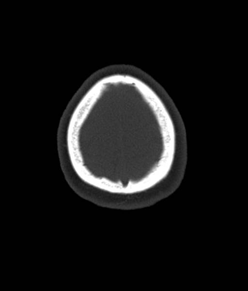 File:Cerebellar metastases - colorectal adenocarcinoma (Radiopaedia 40947-43652 AX Bone C- 2.0 MPR 61).png