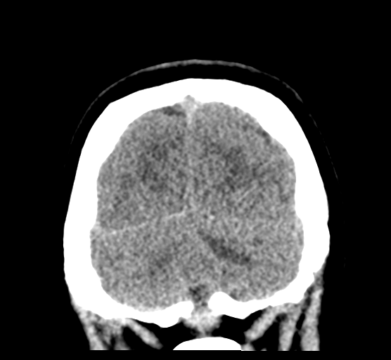 Cerebellar metastases - colorectal adenocarcinoma (Radiopaedia 40947-43652 Coronal non-contrast 80).png