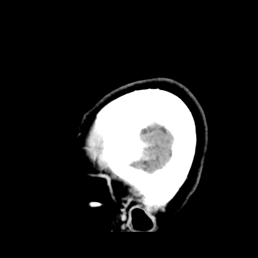 File:Cerebellar metastasis (cystic appearance) (Radiopaedia 41395-44258 F 48).png