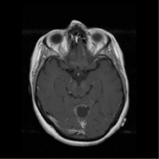 File:Cerebellar metastasis (cystic appearance) (Radiopaedia 41395-44262 Axial T1 C+ 8).png