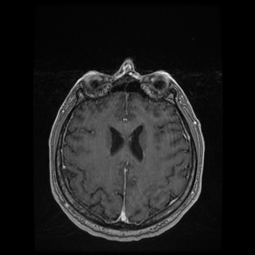 Cerebellar metastasis of pulmonary adenocarcinoma, cavernous venous malformation, and developmental venous anomaly (Radiopaedia 85827-101661 Axial T1 C+ 65).jpg