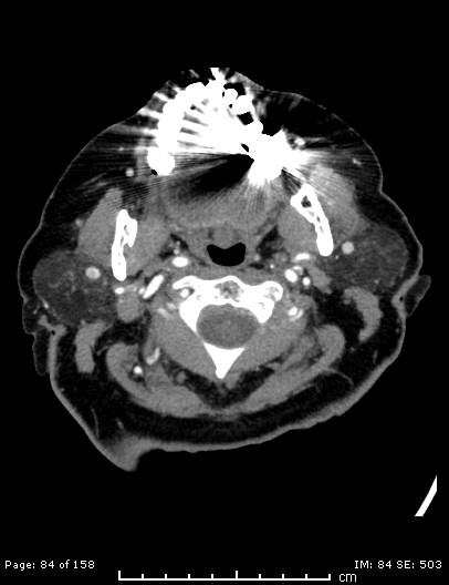 File:Cerebellar strokes due to intracranial giant cell arteritis (Radiopaedia 68799-78510 CT angiogram 84).jpg