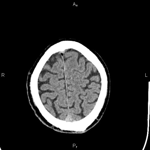 File:Cerebellopontine angle arachnoid cyst (Radiopaedia 85149-100704 Axial With contrast 44).jpg