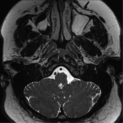 Cerebellopontine angle meningioma (Radiopaedia 48434-53348 Axial T2 Space 26).png