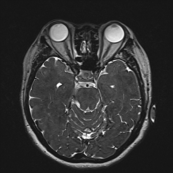 Cerebellopontine angle meningioma (Radiopaedia 53561-59591 Axial 3D volume T2 88).jpg