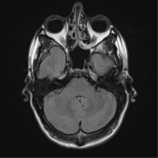 File:Cerebral abscess (Radiopaedia 60342-68009 Axial FLAIR 7).png
